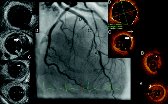 IVUS képe